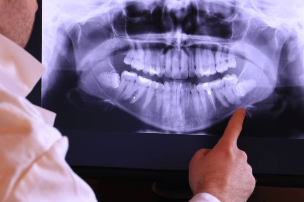 Emergency Dental Filling Replacement in OH